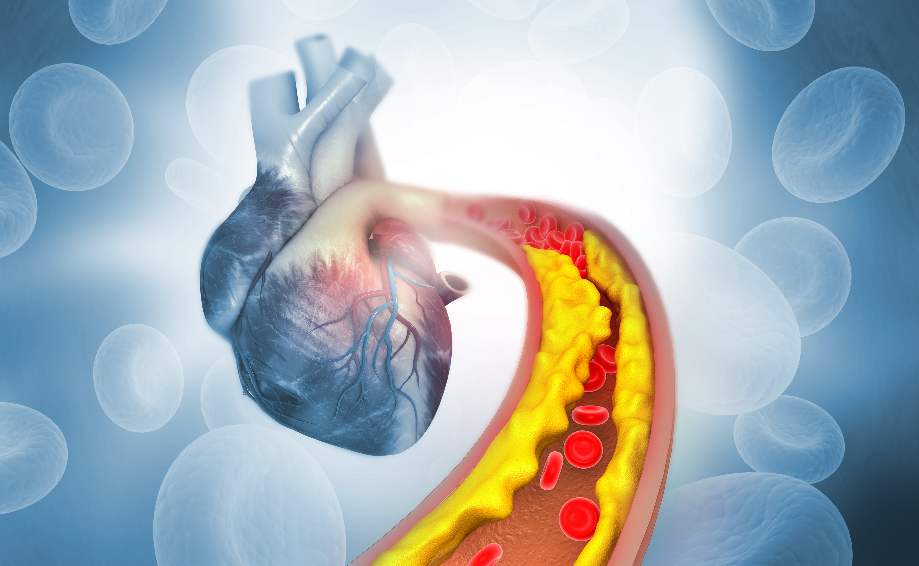 Cholesterol plaque heart